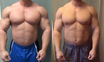 Gynecomastia before 350680