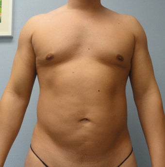 VASER Liposuction (HiDef) before 570288