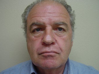 Botox before 531096