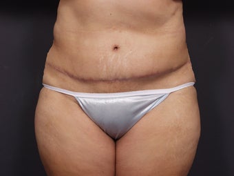 Post Tram Flap Abdomen - 46 Year Old Female for Breast Reconstruction after 643268