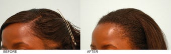 Female Hair Transplant before 137281