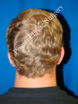 Ear Surgery (Otoplasty) 584563