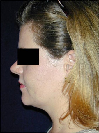 Neck Liposculpture before 312661