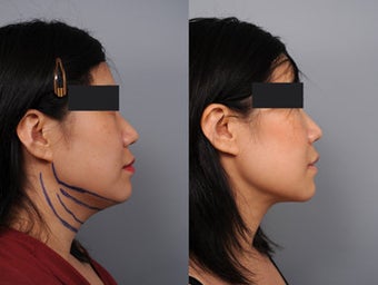 Smartlipo of the neck with Radiesse in the Mid-face before 210768