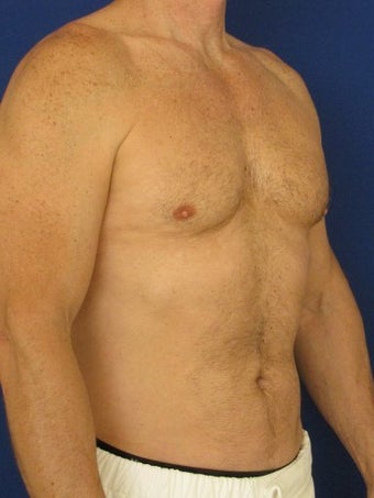 Vaser Hi Def Liposuction of chest, abdomen, back and flanks 422687