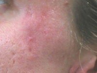 Acne/Acne Scars Treatment with Smoothbeam after 272005