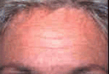 Botox before 154203