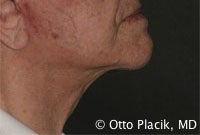 Cervicoplasty after 567304