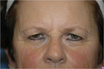 Pretrichial forehead lift and upper blepharoplasty before 377313