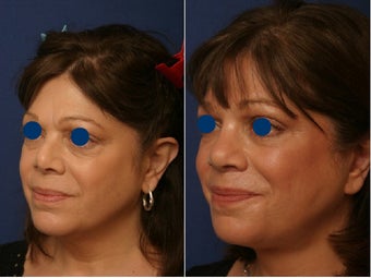 Revision rhinoplasty before and after before 84218