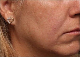 Restylane before 444317