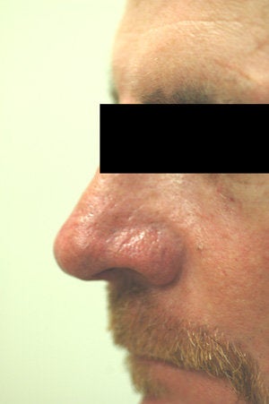 Nose spider vein removal after 106563