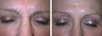 Botox before 112588