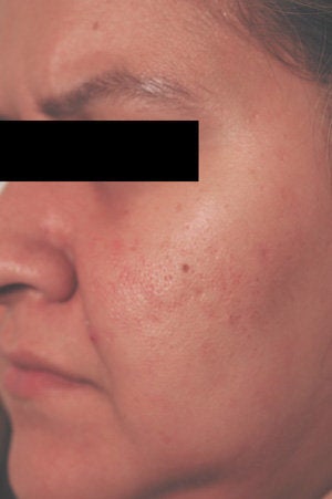 Laser Resurfacing before 89110