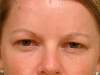 Botox Cosmetic after 375185