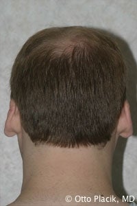 Otoplasty 567309