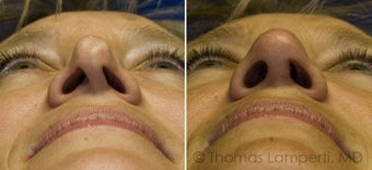 Revision Rhinoplasty with ear cartilage grafting before 233189