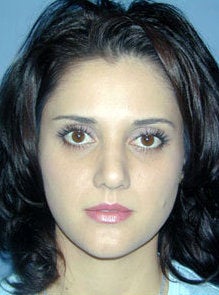 Nose Surgery, Rhinoplasty after 550008
