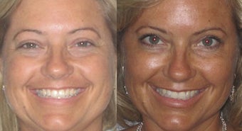 Non-surgical liquid eyelid lift before 353741