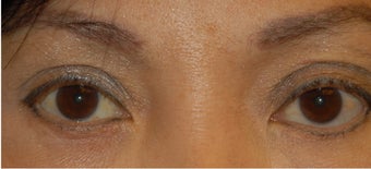 Ptosis Correction after 555502