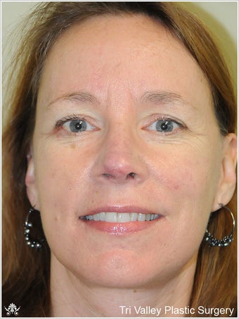 Facelift after 420920