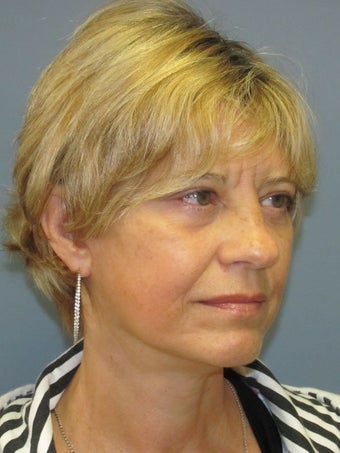 Brow Lift, Eyelid Lift 519165