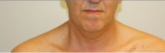 Chin Liposuction 490761