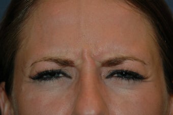 Botox injected in between the eyebrows and into the forehead before 577107