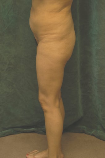 Women's Buttocks Augmentation before 518115