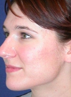PDT for acne after 376114
