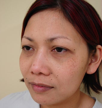 Upper eye lid surgery before 281925