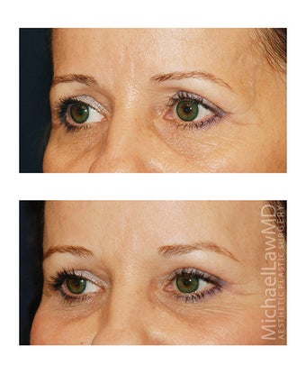 Brow Lift before 495496