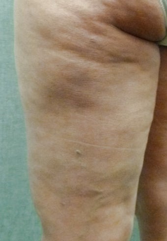 Cellulaze before 582382