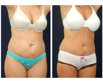 Abdominoplasty - Tummy Tuck after 396151