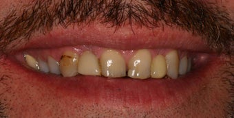 Full Mouth Reconstruction 345554