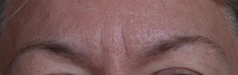 Botox before 269755