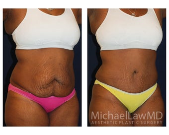 Abdominoplasty - Tummy Tuck after 396144