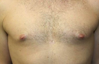 Smart-Lipo of the Chest, Liposuction, Gynecomastia before 402440