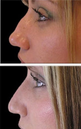 Radiesse for nose reshaping before 6519