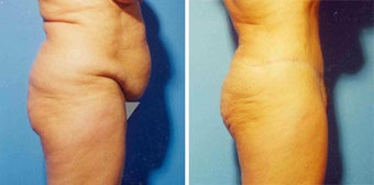 Abdominoplasty before 294758