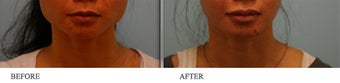 Botox Jaw (masseter) reduction before 422893