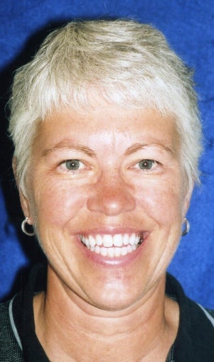 Orthodontic braces with miniscrew support to close openbite 404689