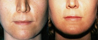 Lip Augmentation before 633530