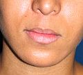 Lip Lift before 99428