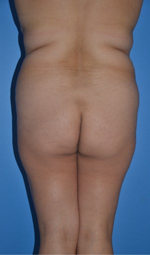 Liposuction and Abdominoplasty before 555508
