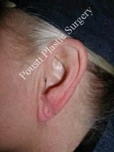 Earlobe Repair Surgery before 612309
