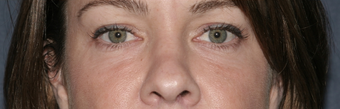 Restylane after 596241