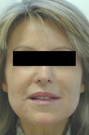 Laugh Lines with Juvederm in Anaheim, CA after 204771