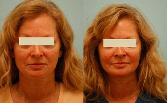 Fat Transfer/Fat Grafting/Facial Rejuvenation before 136346