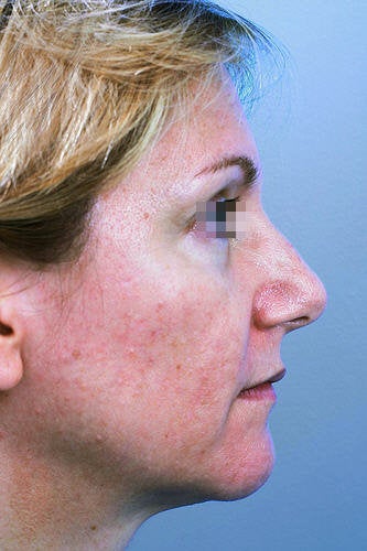 Fractional CO2 Laser Resurfacing before 114176